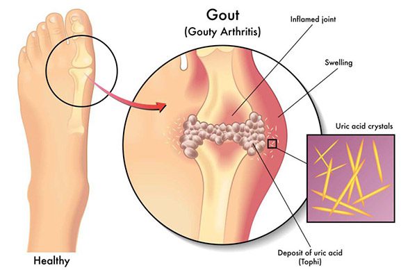 Alkaline Water Benefits for Gout